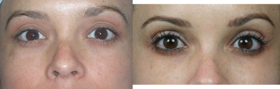 Latisse for Eyelashes - 
	Latisse
