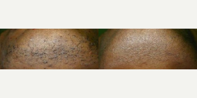 Man treated with Laser Hair Removal - Man treated with Laser Hair Removal