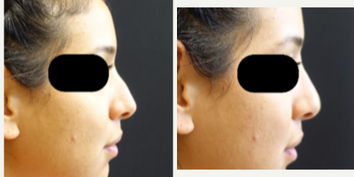 25-34 year old woman treated with Non Surgical Nose Job - A liquid rhinoplasty is a non-surgical procedure that can enhance the nose. She was treated with Juvederm Voluma to improve the overall shape of the nose. The procedure can be done in the office in under 30 minutes.