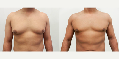 Man treated with Gynecomastia Surgery - Man treated with Gynecomastia Surgery