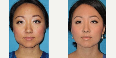Woman treated with Jaw Reduction - Woman treated with Jaw Reduction using Botox to masseter muscle (upper jaw area) to narrow her facial width for a more feminine face