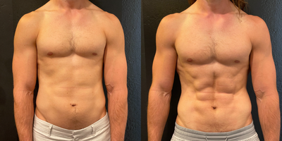 35-44 year old man treated with truSculpt flex - 36 year old man before and after four treatments of trusculpt flex to the bi's/tri's/abs