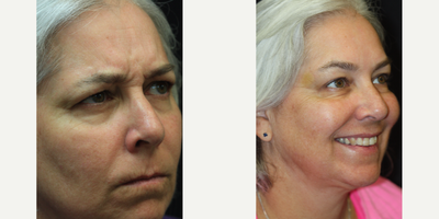 50 year old woman treated with Botox for Migraines - 50 year old woman seeking to address early signs of aging consulted with Dr. Kris Reddy FACS. Dr. Reddy performed Botox about 40 units and dermal fillers (1 syringe of Juvederm Ultra in the nasolabial folds and perioral lines and 1 syringe of Voluma for the lower face and chin area). Patient wanted to have Botox performed for cosmetic reasons and to treat migraine headaches.