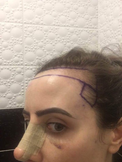 Hairline Lowering Istanbul Hairlines Review Realself