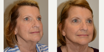 65-74 year old woman treated with Facelift - Patient's surgical procedure included a Facelift, Fat Grafting to the Face and Lower Blepharoplasty