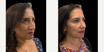 45-54 year old woman treated with Rhinoplasty - This patient who is from India requested a rhinoplasty to reduce a dorsal hump and droopy tip. I performed an ultrasonic rhinoplasty to reduce the dorsal hump/ This technique uses a device called a piezotome to sculpt the nasal bones and avoids hammers and chisels. This technique is more precise and enhances the recovery with reduced bruising and swelling. The tip needed supporting to correct a droopy tip. From the from view the bulbous tip has been refined and the dorsal irregularities refined.All of this is performed in a manner which suits her ethnicity and the final result softens her face whilst enhancing her beautiful facial features.