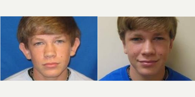 17 or under year old man treated with Ear Surgery - 17 or under year old man treated with Ear Surgery