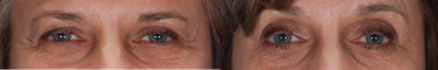 Latisse - This lady had a complaint of thin, short eyelashes. She desired fuller, more lushious eyelashes. She underwent Latisse treatments. LATISSE solution is a prescription treatment for hypotrichosis used to grow eyelashes, making them longer, thicker and darker. Eyelash hypotrichosis is another name for having inadequate or not enough eyelashes.&nbsp;
