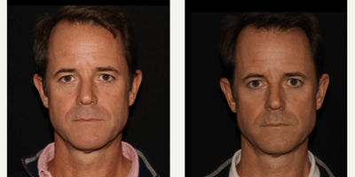 Man treated with Emface - Emface