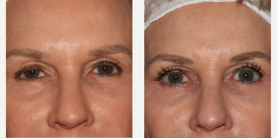 Woman treated with Emface - Emface