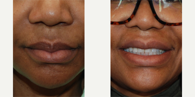 55-64 year old woman treated with Lip Reduction - The aging process also affects the lips, leading to a droopier appearance with time. Our lovely patient was concerned by the overhanging appearance of the central portion of her upper lip especially with smiling. Her after photos are seen very early after a upper lip reduction surgery. All incisions are on the inside of her mouth, and as you can see, there is minimal downtime.