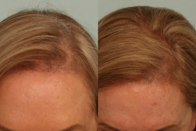 55-64 year old woman treated with Hair Transplant - Hair Transplant
