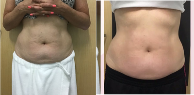 45-54 year old woman treated with Skin Tightening - Patient was treat with InModes BodyFX/Contoura for skin tightening, cellulite reduction, and for body contouring to kill fat.