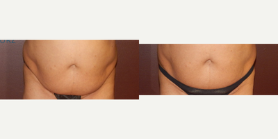 45-54 year old woman treated with Weight Loss - Fat loss using Ultraslim,LED light therapy. 6 treatments after she had lost inches off the waist and tightened the skin in the belly area. Notice the sag is gone.