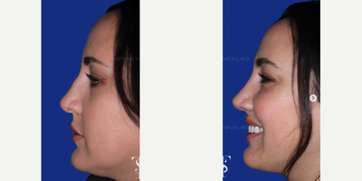 25-34 year old woman treated with Revision Rhinoplasty - 25-34 year old woman treated with Revision Rhinoplasty