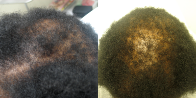 45-54 year old woman treated with Hair Loss Treatment - Prp/Microneedling to restore hair follicles