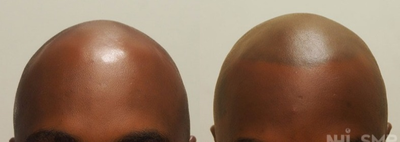 35-44 year old man treated with Hair Loss Treatment Scalp MicroPigmentation SMP - Scalp MicroPigmentation SMP