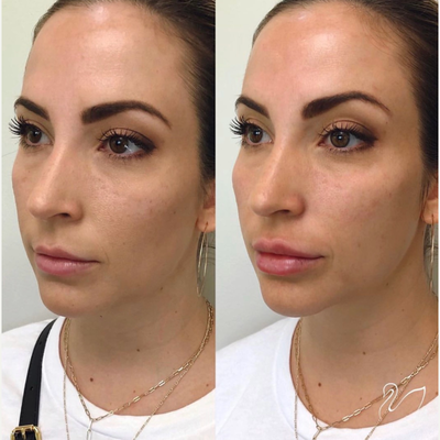 25-34 year old woman treated with Injectable Fillers - Beautiful cheek filler and lip filler results at The Skin Center Pittsburgh!