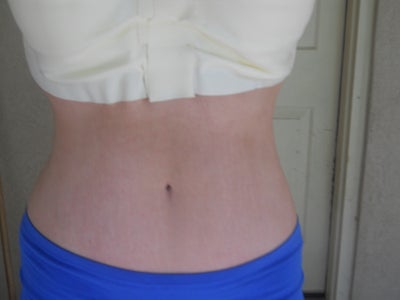 Fraxel Co2 For White Stretch Marks Review Realself