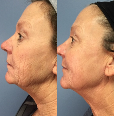55-64 year old woman treated with Active FX - Patient noticed significant improvement to skin tone, texture and wrinkles after receiving one Active FX laser treatment.