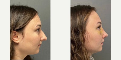 25-34 year old woman treated with Rhinoplasty - Patient is 1 week post-op rhinoplasty.