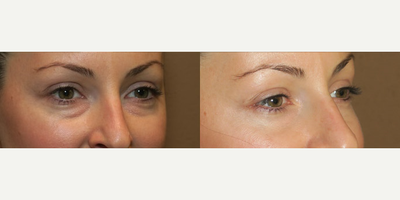 Woman treated with Eyelid Surgery - Woman treated with Eyelid Surgery