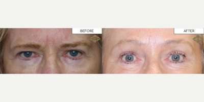 Woman treated with Brow Lift - Before & After Pretrichial Browlift
