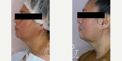 Woman treated with BeautiFill, Chin Liposuction, Liposculpture - BeautiFill - Chin Liposuction Before & AfterBeautiFill is a great option if you want liposuction in one targeted area, if you want full liposuction in multiple areas or if you'd like to use that precious fat to plump other areas of your body!