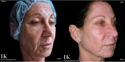 Woman treated with TotalFX - This patient underwent TotalFX laser resurfacing. The DeepFX laser handpiece was used to treat around the eyes and around the mouth. The ActiveFX laser handpiece was used to treat the entire face.