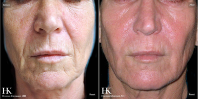 Woman treated with TotalFX - This patient underwent TotalFX laser resurfacing. The DeepFX laser handpiece was used to treat around the eyes and around the mouth. The ActiveFX laser handpiece was used to treat the entire face.