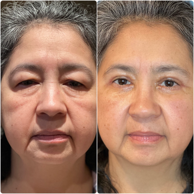 45-54 year old woman treated with Dermal Fillers, Cataract Surgery, LASIK, Botox, YAG Laser - one month after bilateral upper and lowe