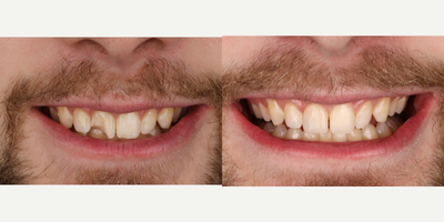 25-34 year old man treated with Tooth Repair - I am able to use Advanced Cosmetic Bonding to restore this chipped tooth.