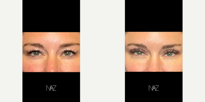 35-44 year old woman treated with Eyelid Surgery - Excess skin on upper eyelids, bilateral blepharoplasty.