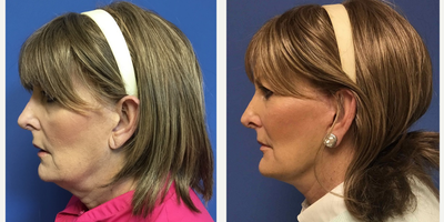 65-74 year old woman treated with Mini Lift - 74 year old woman who wanted a natural and refreshed appearance