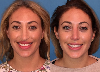 Woman treated with Revision Rhinoplasty - Woman treated with Revision Rhinoplasty
