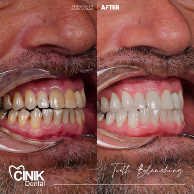 25-34 year old man treated with Teeth Whitening - Teeth Whitening