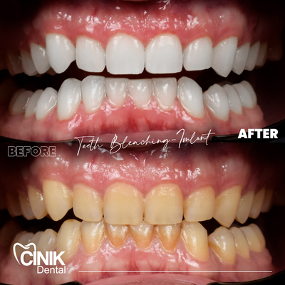25-34 year old man treated with Teeth Whitening - Teeth Whitening