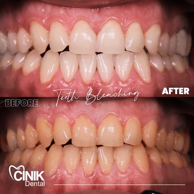 25-34 year old man treated with Teeth Whitening - Teeth Whitening