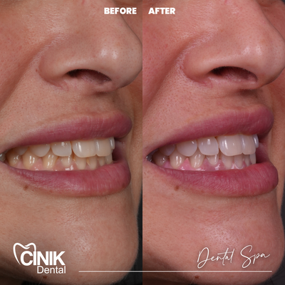 25-34 year old man treated with Teeth Whitening - Teeth Whitening
