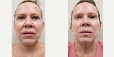 55-64 year old woman treated with Sylfirm X - Patient received 3 sessions of our SylfirmX protocol on face and neck, combined with Benev Exosomes and Alastin Skincare. One month between the 1st and 2nd session and 2 months for the 3rd session. Pictures were taken 2 months after her 3rd session