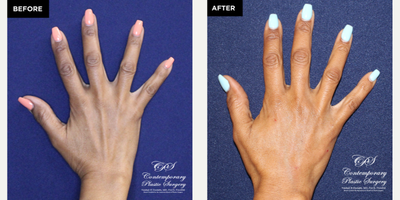 55-64 year old woman treated with Radiesse, Hand Rejuvenation - The patient wanted to rejuvenate the appearance of her hands. Radiesse was placed to help obscure the visibility of tendons and veins and re-volumize the back of the hands.