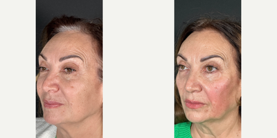 55-64 year old woman treated with Voluma - Non surgical cheek augmentation using Voluma.
