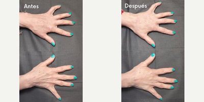 Woman treated with Hand Rejuvenation - Radiesse is, an injectable product classified in the category of Collagen Stimulants composed of a mineral called calcium hydroxyapatite. It is able to stimulate collagen type III in first stays and subsequently type I collagen which are matrix proteins and skin bra. This procedure has no degree of disability, takes less than 30 minutes, and has no major aftercare or major contraindications