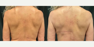 55-64 year old woman treated with Breast Reconstruction with Latissimus Flap - This 59-year-old patient was diagnosed with breast cancer in the left breast and initially planned to undergo a left mastectomy with implant-based reconstruction, as she previously had cosmetic breast implants. After surgery, positive margins were identified, requiring additional treatment and ultimately leading to bilateral mastectomies.To achieve optimal reconstruction and symmetry, she proceeded with left latissimus dorsi (LD) flap reconstruction with implant placement, along with an implant exchange on the right side to match the reconstructed breast. This approach allowed her to restore breast shape while maintaining balanced, natural-looking results.