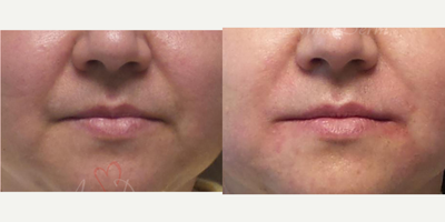 45-54 year old woman treated with Juvederm, Radiesse, Vollure, Restylane, Bellafill - Treatment of nasolabial folds (laugh lines) & marionette lines with Juvederm, Radiesse, Vollure, Restylane or Bellafill