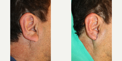 55-64 year old man treated with Earlobe Surgery - This gentleman is in his late 50s has always been self-conscious about the size of his earlobes. He presents desiring earlobe reduction surgery. While there are various ways to perform this procedure, in this particular case, successive portions of his ear lobes were removed until a more normal and tidy ear lobe was created.  Incisions similar to those for a facelift were used to hide the scars.  These pictures are before and immediately following the surgery. His ear lobes have swelling due to retained local anesthesia as well as swelling from the procedure itself. This was performed under local anesthesia solely and he tolerated this very well. The stitches will stay in for seven days.