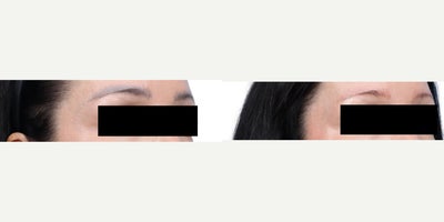 45 year old woman treated with Tattoo Removal - This 45-year-old patient sought removal of an unwanted eyebrow tattoo. Laser tattoo removal sessions were performed to gradually lighten and clear the pigment. The after images show significant fading and a more natural skin appearance.