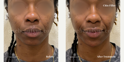 25-34 year old woman treated with Chin Filler, Restylane Lyft - An early 30s woman received chin filler for augmentation, transforming her round chin into a more pointed shape for better facial balance.