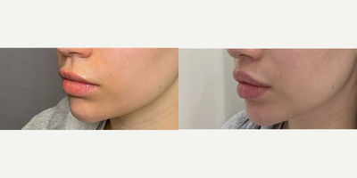 35-44 year old woman treated with Lip Lift, Lip Fillers - Lip lift surgery and fillers.