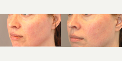 35-44 year old woman treated with Mole Removal - Excision of cosmetic lesion in alar crease.